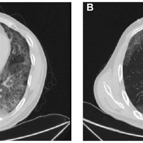 Hrct Images A B Ground Glass Opacity And Patchy Shadow On Bilateral