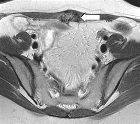 Atypical Sites Of Deeply Infiltrative Endometriosis Clinical