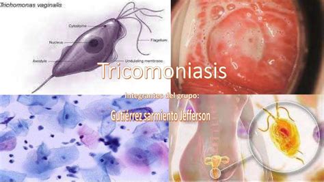 Tricomoniasis Apuntes De Medicina Salud Udocz