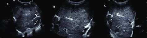 Ultrasound shows altered coarse echotexture of liver with architectural... | Download Scientific ...