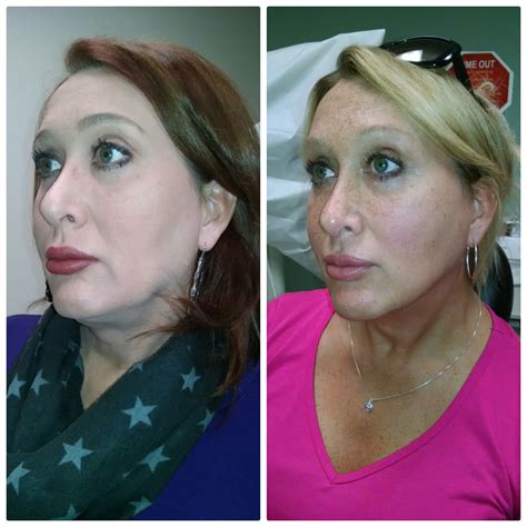 Best Neck Lift In Long Island Platysmaplasty By Dr Doshi