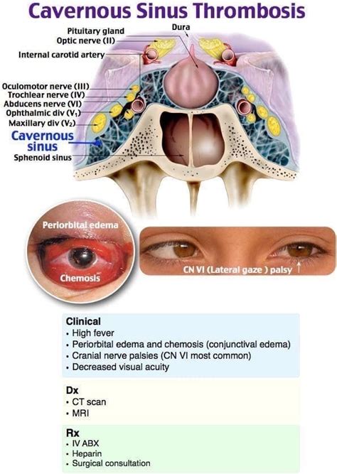 Oren Gottfried Md On Twitter Know All About Cavernous Sinus Thrombosis By Rosh