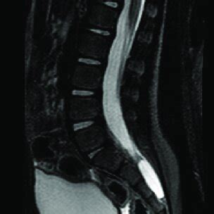 MRI highlighting the spinal cyst with same contrast as urine in bladder ...