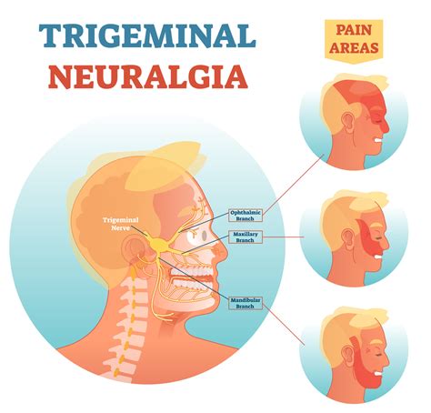 What Is Trigeminal Neuralgia What Causes Trigeminal Neuralgia What ...