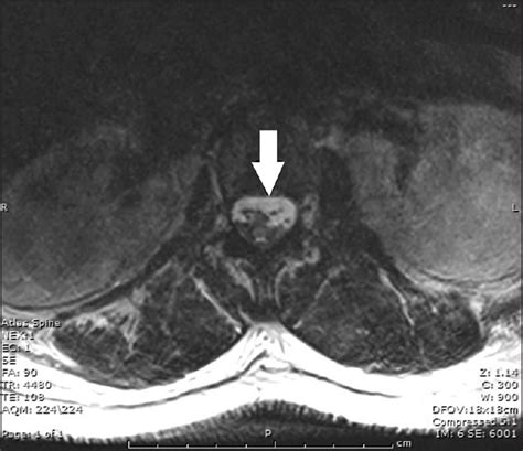 Epidural Hematoma MRI