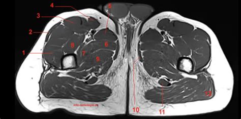 Thigh MRI 14. Diagram | Quizlet