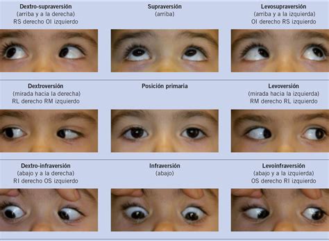 Estrabismo En Niños De 1 A 2 Años Causas Y Tratamientos