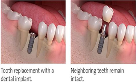 Costa Rica Dental Center Discount Prices Implant Crowns