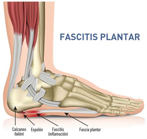 Cirugía Ecoguiada de Fascitis Plantar y Espolón en Donostia