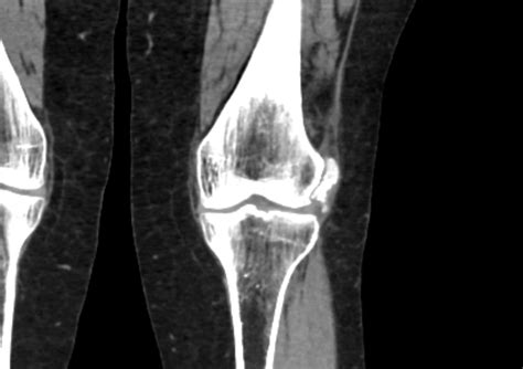 Calcification Of The Lateral Collateral Ligament Lcl Of The Knee Image