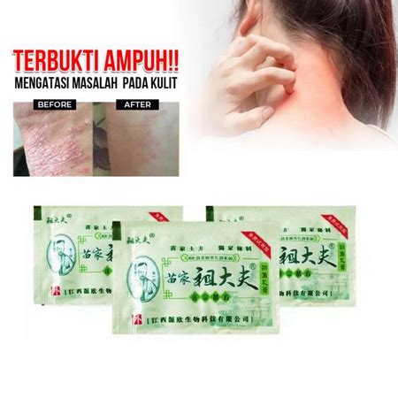 Jual Obat Gatal Original Zudaifu Salep Gatal Salep Kulit Jamur