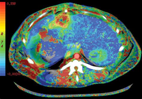 CT Color Mapping Of The Arterial Enhancement Fraction Of VX2 Carcinoma