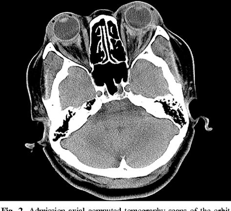 Figure 2 from Bilateral Retrobulbar Hemorrhage and Visual Loss ...