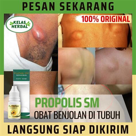 Obat Menghilangkan Benjolan Di Tubuh Obat Penghilang Semua Jenis