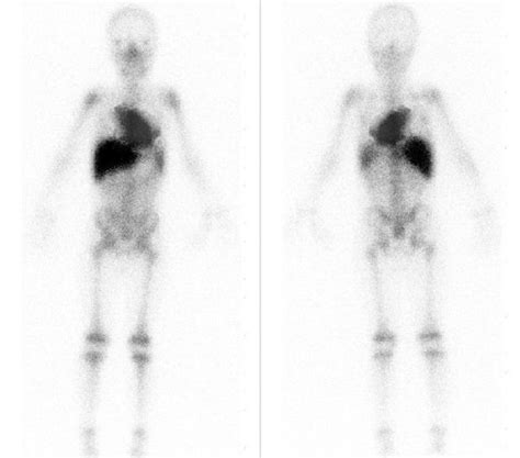 Gallium-67 whole-body scan of the patient showing intense uptake in ...