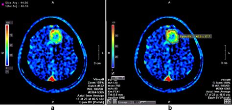 A 41 Year Old Male Patient With Meningothelial Meningioma In The Left