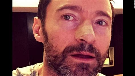 Another Skin Cancer For Actor Hugh Jackman Cnn