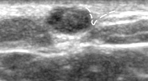 Distinguishing Breast Skin Lesions From Superficial Breast Parenchymal