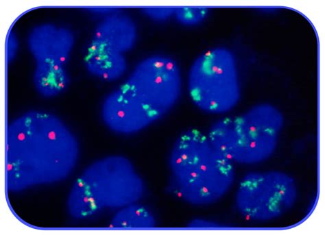 FISH en el diagnóstico y seguimiento oncológico ANNAR Health