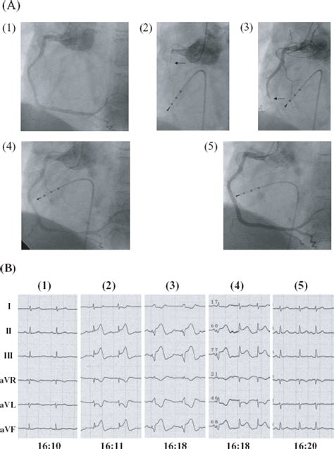 A representative case of severe coronary spasm that occurred after the ...