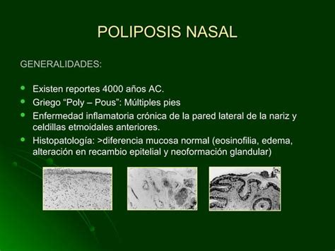 Cirugia Endoscopica En Poliposis Nasal Ppt