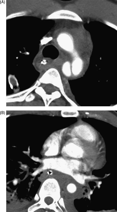 Diagnosis Of Blunt Traumatic Aortic Injury Still A Nemesis