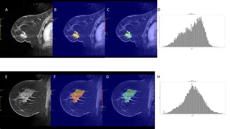 DCE MRI Radiomics Analysis In Differentiating Luminal A And Luminal B