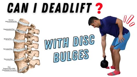 How To Do Deadlift With Lumbar Spine Disc Bulges Youtube