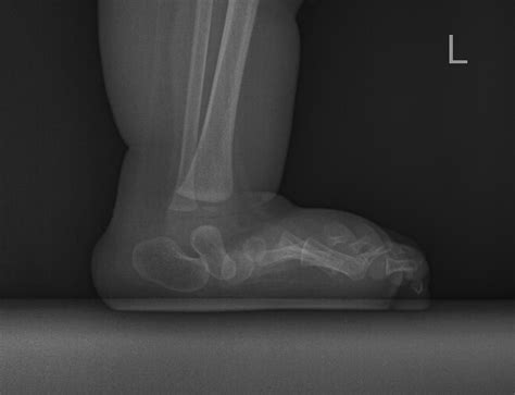 Bilateral Congenital Vertical Talus Rocker Bottom Foot Image