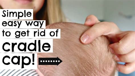 How To Get Rid Of Cradle Cap In One Try Newborn Youtube