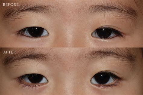 Entropion Eyelid Repair Before & After Photos Kirkland Bellevue | Marina Park Plastic Surgery