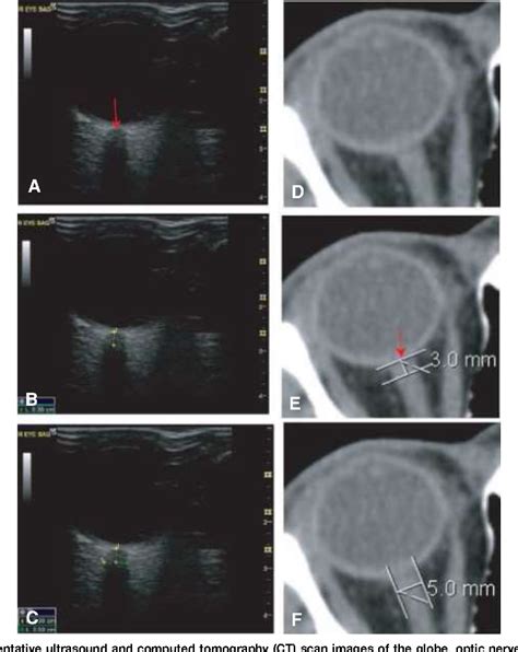 Accuracy Of Optic Nerve Sheath Diameter Measurement By Emergency Physicians Using Bedside