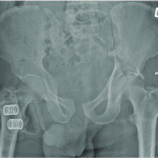 Initial Antero Posterior AP Pelvic Radiograph Showing Pelvic Ring