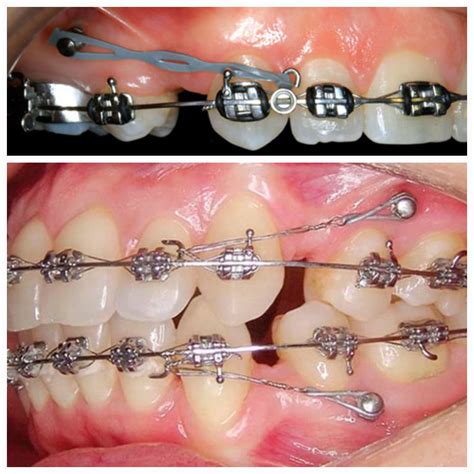 Mini Implante Ortodoncia Clínica Dental Cevallos