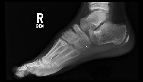 Ortho Dx Unresolved Ankle Pain After A Sports Injury Clinical Advisor