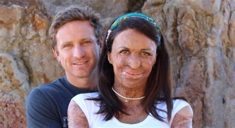 A Grass Fire Disfigured Her Face And Body But Her Husband Has Shown