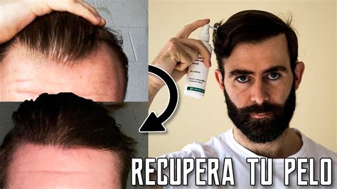 El Mejor Tratamiento Para La Alopecia Androgen Tica Youtube