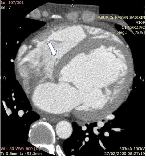 Vegetation At The Tricuspid Valve Arrow Visualized From Cardiac Ct Scan Download Scientific