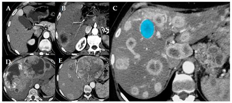 Cancers Free Full Text Liver Tumor Burden In Pancreatic Neuroendocrine Tumors Ct Features