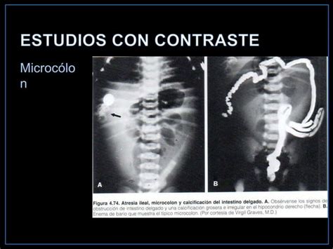 Atresia Yeyunal Radiologia Ppt
