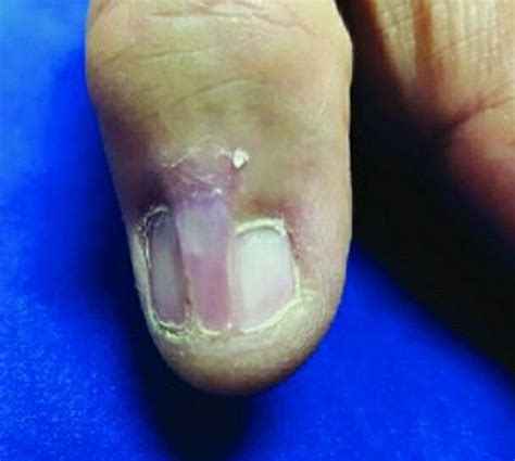 Skin Around Nail Plate Stretching Abnormally Due To Serious Injury Or