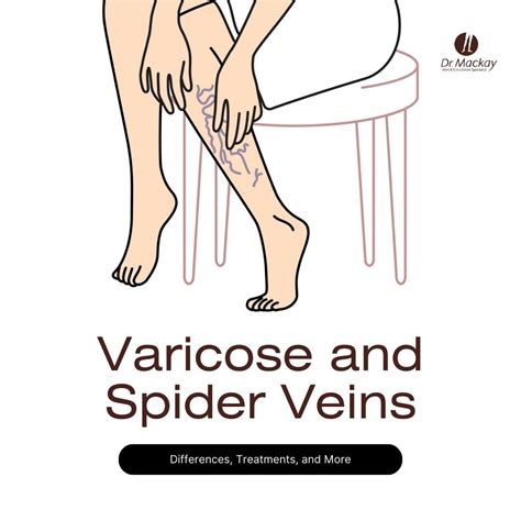 Spider Veins Vs Varicose Veins Causes And Treatments By Dr Mackay