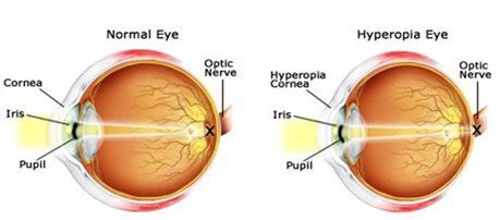 Harvard Eye Associates | Eye Surgery for Farsightedness | San Clemente