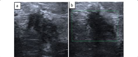 Right breast ultrasound shows an irregular, ill-defined hypoechoic... | Download Scientific Diagram