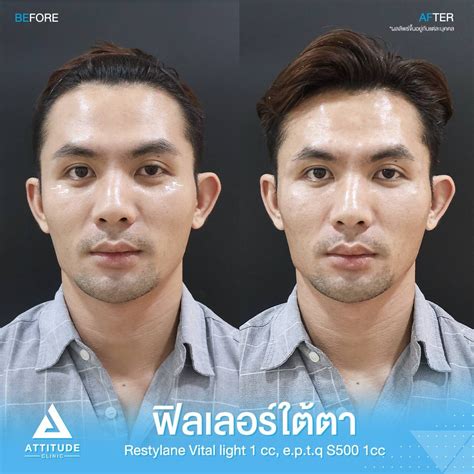 รีวิว Attitude Clinic ห้วยขวาง รีวิวฉีดฟิลเลอร์ใต้ตา Restylane Vital