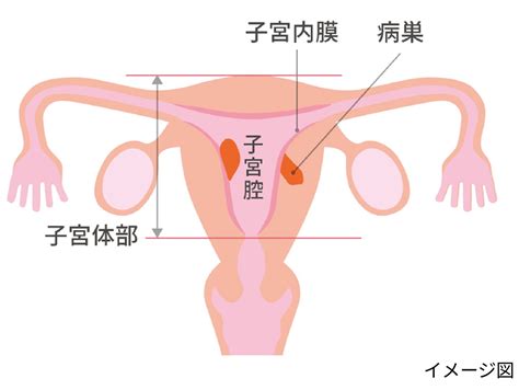 子宮体がんとは？診察と治療の内容、受診タイミング｜基礎体温でカラダと話そう 【テルモ】