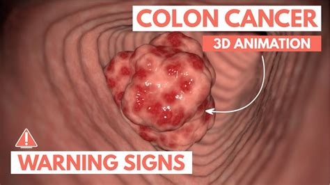 Unmasking Colon Cancer 5 Warning Signs You Shouldnt Ignore Schooltube