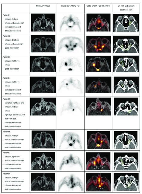 Optic Nerve Sheath Meningiomas Onsm On Mri And Pet Images In All