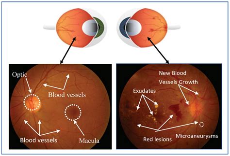 Applied Sciences Free Full Text Automated Diabetic Retinopathy