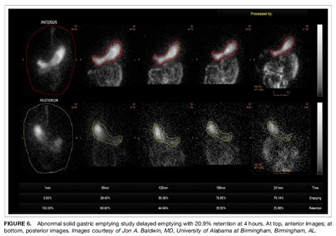 Gastroparesia Gastro M Rida